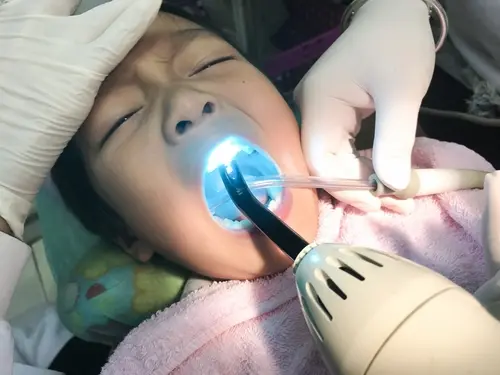 Dental Sealants - Kid Grins Dental Sealants - Kid Grins
