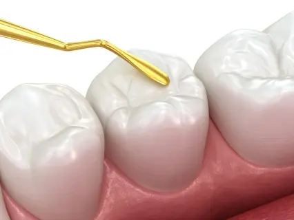 webp/Dental-Sealants-row-Kid-Grins.webpvs3maf.webp