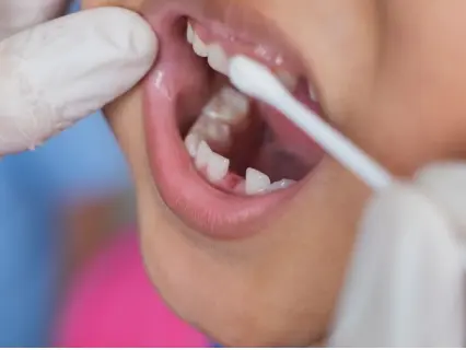 How Fluoride Treatments Work - Kid Grins