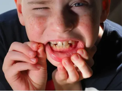 Knocked Out Tooth Row 1 - Kid Grins Is Who You Want to Help