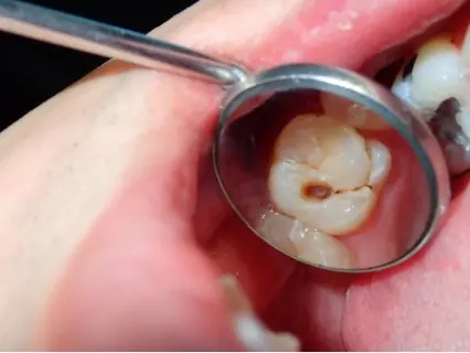 The Versatility of Dental Fillings -Kid Grins