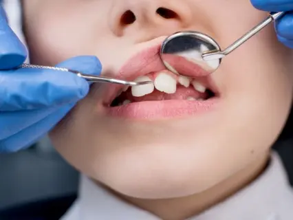 Types of DentalEmergencies for Kids - Kid Grins Types of Dental Emergencies for Kids - Kid Grins