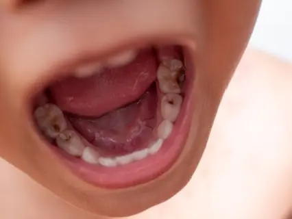 Why Tooth-Colored Fillings Are Great For Kids - Kid Grins Explains Why